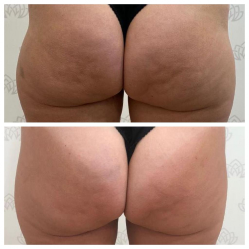 Elevaci�n de gl�teos.